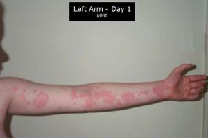 Cholinergic urticaria treatment