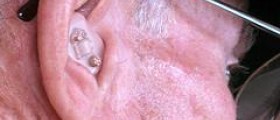 Choosing the right hearing aid