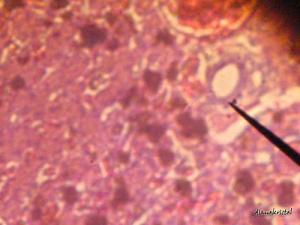 Chronic bile duct diseases