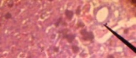 Chronic bile duct diseases