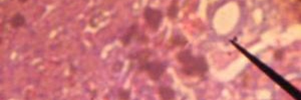 Chronic bile duct diseases