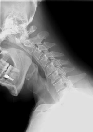Chronic cervical myelopathy