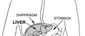 Chronic cirrhosis of the liver