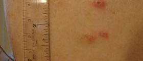 Chronic crohn's disease