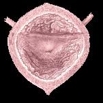 Chronic cystitis in men