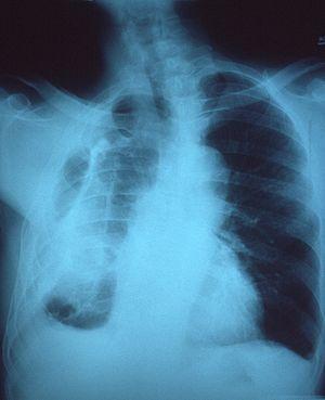 Chronic fibrosing alveolitis