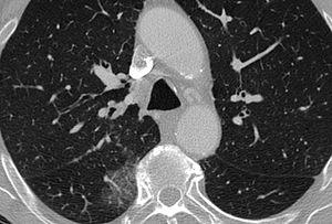Chronic fibrosing mediastinitis