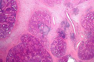 Chronic functional dyspepsia