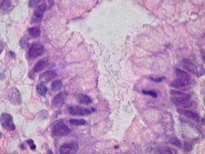 Chronic gastritis problem