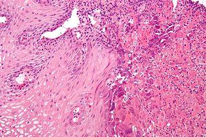 Chronic genital herpes