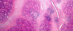 Chronic genital herpes outbreaks