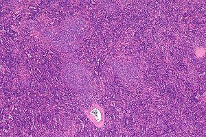 Chronic genitourinary diseases