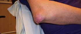 Chronic gout treatment