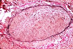 Chronic granulomatous disease