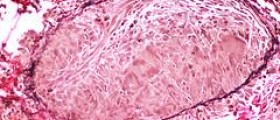 Chronic granulomatous disease