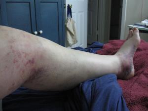 Chronic leg pain in children
