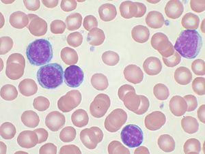 Chronic leukemia facts