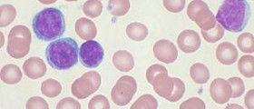 Chronic leukemia facts