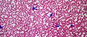 Chronic mononucleosis facts
