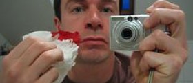 Chronic nosebleeds facts