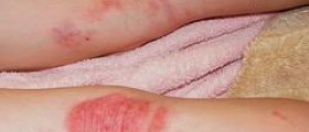 Chronic nummular dermatitis