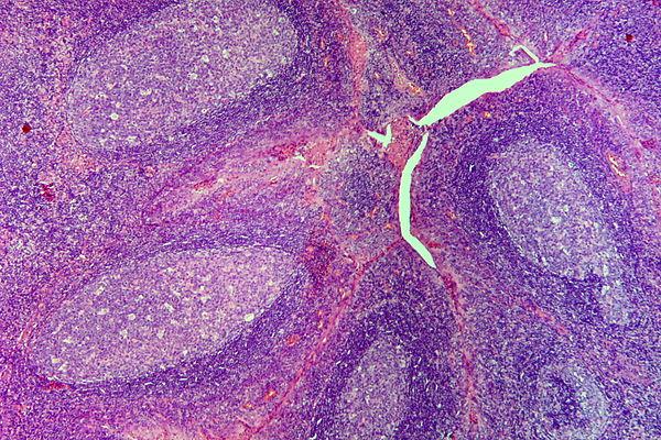 Chronic osteomyelitis facts