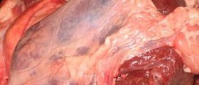 Chronic pericarditis facts