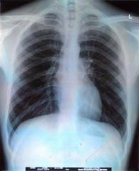 Chronic rib cartilage injury