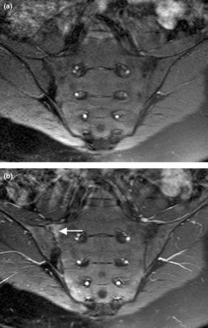 Chronic sacroiliac pain