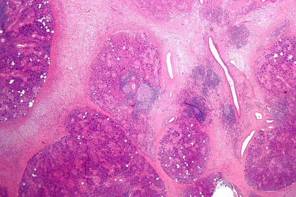 Chronic sepsis facts