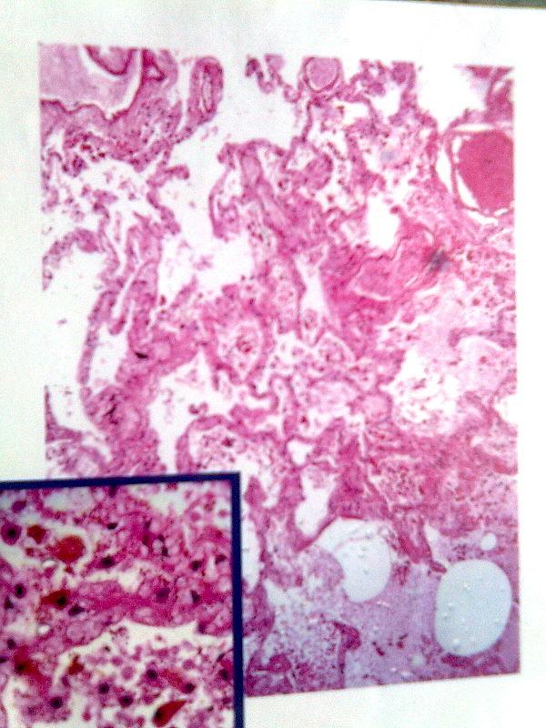 Chronic telogen effluvium