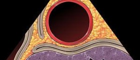 Classification of aortic aneurysm