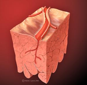 Clogged artery symptoms
