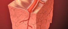 Clogged artery symptoms