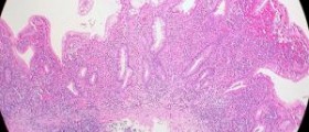 Colitis dietary guidelines
