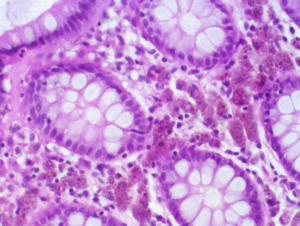 Colon cleansing procedure