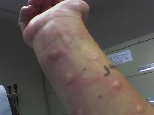Common allergies and their symptoms and pathologies
