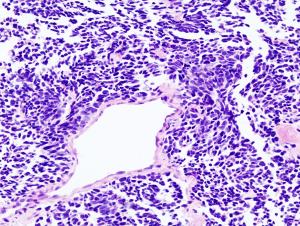 Common causes of lung cancer