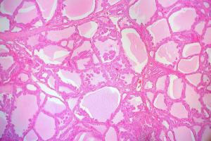 Complications of dysphagia