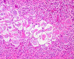 Complications of genital herpes
