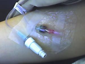 Complications of IV therapy