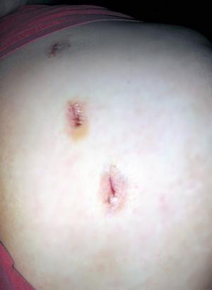 Complications of laparoscopic cholecystectomy