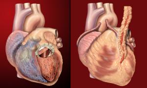 Complications of quadruple bypass surgery