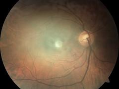 Conditions, diseases and irregularities which affects retina and vitreous