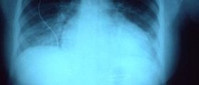 Congestive heart failure prognosis
