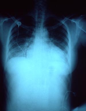 Congestive heart failure symptoms