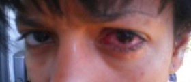 Conjunctivitis home remedy