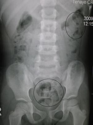 Constipation in infants treatment