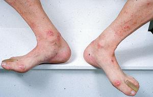 Contact dermatitis feet