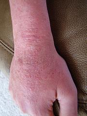 Contact dermatitis scalp